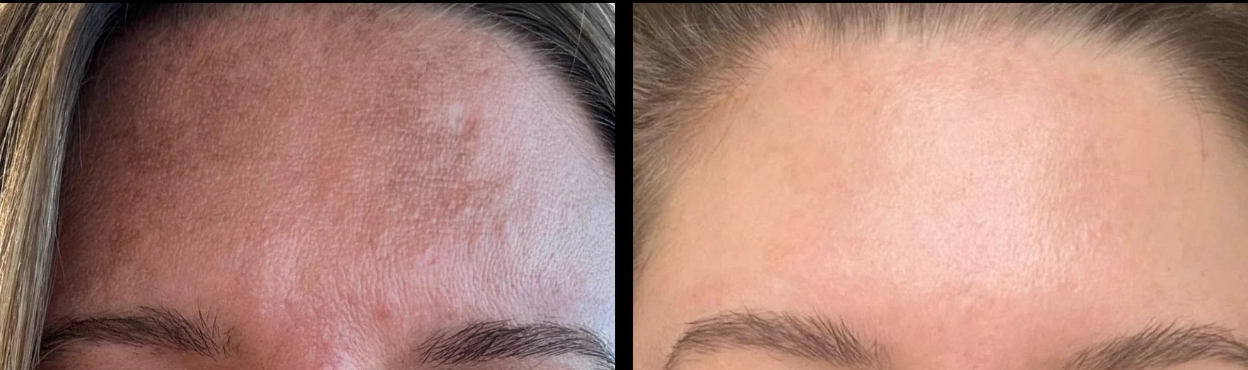 Dermaroller microneedling et son nettoyant Roller Cleaner - Image 6