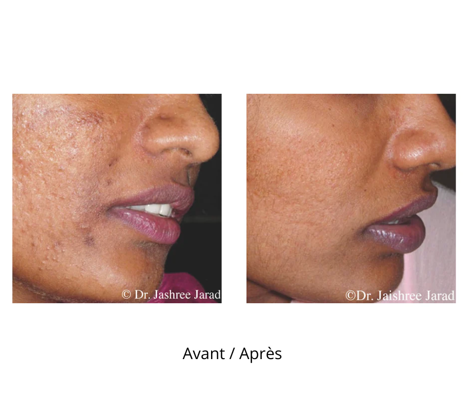 Dermaroller microneedling professionnel 9 rangées d’aiguilles avec profondeur de 1 mm - Image 7