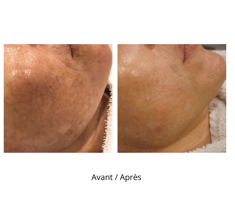Dermaroller microneedling professionnel 9 rangées d’aiguilles avec profondeur de 1 mm - Image 6