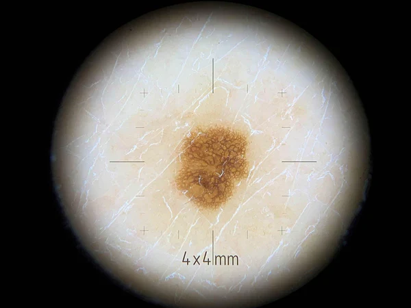 Embout de contact petites surfaces pour DL4 Dermlite - Image 3
