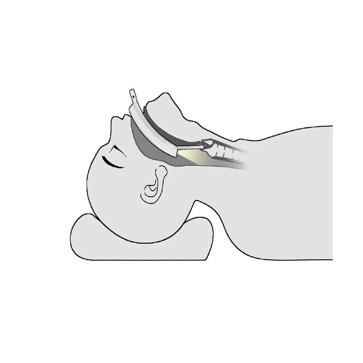 Laryngoscope vidéo LaryngoOne - One Medical - Image 6