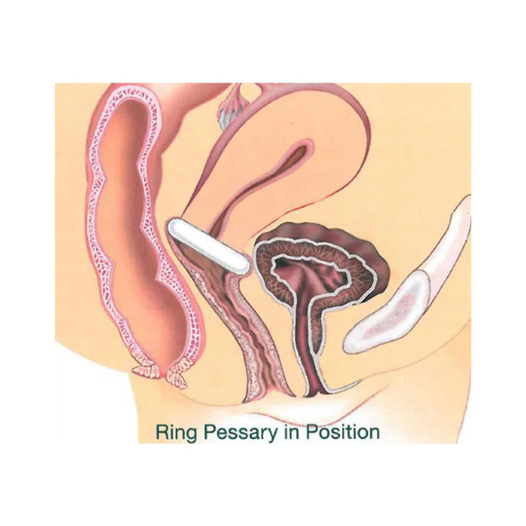 Kit Pessaire Gyn&Ring pliable complet - Image 2
